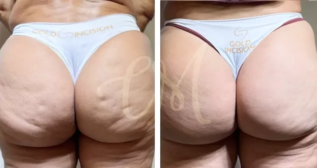 Imagem interna GoldIncision antes depois destaque 1