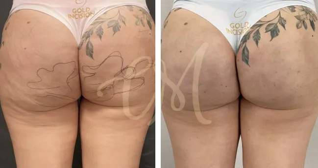 Imagem interna GoldIncision antes depois destaque 2