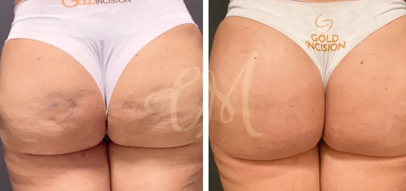 Imagem interna GoldIncision antes depois principal